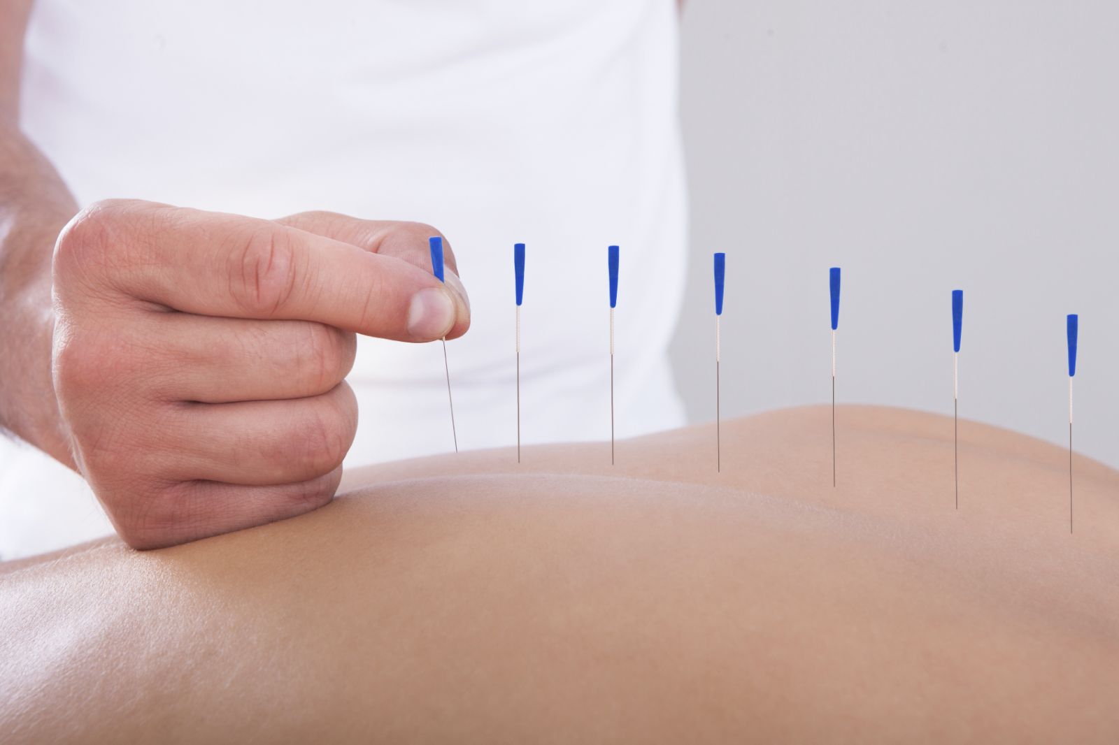 Learn how Wish Recovery integrates acupuncture into your recovery plan